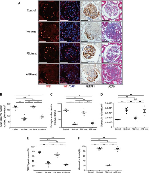 Histological and podometric analysis of the effects of steroids or ARB treatment in a rat model of anti-GBM nephritis. (A) Representative histology in a rat model of anti-GBM nephritis for the control, no treatment, steroid treatment and ARB treatment groups. From upper to lower, micrographs are from control, no treatment, steroid treatment and ARB treatment groups after NTS injection. Far-left and second-left panels show podocyte nuclei identified using WT1 and WT1/DAPI immunofluorescence staining. Second-right panel shows podocytes identified using GLEPP1/peroxidase. Far-right panel shows Azan staining (bar = 50 μm). (B) Quantification of histology using WT1-positive podocyte nuclear number per glomerular tuft. (C) Quantification of podocyte density. (D) Quantification of glomerular volume. (E) Percentage of glomerular tuft area that was positive for GLEPP1. (F) Percentage of glomerulosclerosis using Azan staining. While the no treatment and ARB treatment groups showed significant depletion of about 60% of podocytes and glomerulosclerosis in about 80% of glomeruli by 28 days after NTS injection, the steroid treatment group had a reduction in podocyte density of 15% compared with the control and was associated with only 20% of glomeruli showing glomerulosclerosis. n = 6 for the control group, n = 7 for the no treatment group, n = 6 for the steroid treatment group and n = 5 for the ARB treatment group. ns = non-significant, *P < 0.05 and **P < 0.01, assessed using one-way ANOVA followed by the Tukey test. Part (C) was assessed using the Kruskal–Wallis test followed by the Dunn test. PSL, predonisolone.