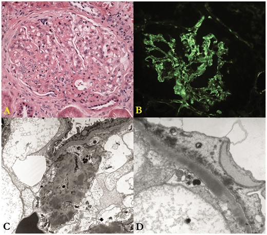 Native kidney biopsy. (A) The glomerulus shows moderate mesangial hypercellularity and mild focal thickening of the capillary walls; the structural changes are best characterized as a membranoproliferative pattern of injury. (B) There is diffuse, fine-granular deposition of C3 along the glomerular capillary walls and in the mesangium; the deposits are only very weakly positive for IgM and negative for IgG and IgA (not shown). (C) This low-magnification electron micrograph shows many discrete mesangial electron dense deposits. (D) This electron micrograph shows a large, confluent and ill-defined intramembranous dense deposit and marked effacement of the foot processes of the glomerular visceral epithelial cell.