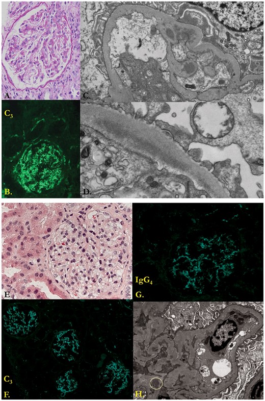 Allograft biopsies performed on POD 14 (A–D) and POD 50 (E–H). The POD 14 biopsy is remarkable for glomeruli without proliferation (periodic acid–Schiff) (A), associated with 3+ deposition of C3, trace staining for IgM and no staining for IgG and IgA (B). EM shows intermediately electron dense granular deposits in the mesangium (C) and subendothelium (D). Diagnosis: recurrent C3GN with associated acute tubular necrosis (not shown). After 36 days later, the POD 50 shows similar glomerular changes by light microscopy (hematoxylin and eosin) (E), and C3 immunoflourescence (F). This time there was also low-level deposition for IgG2 and IgG4 (G) as well as Kappa, secondary to the eculizumab therapy. EM revealed a similar pattern of deposition [mesangial deposits enclosed by circle], (H) although the amount of extramesangial deposition was thought to be somewhat less than in the prior biopsy.