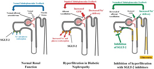 Actions of SGLT-2 inhibitors on the renal microcirculation in patients with DM. Under physiological conditions, SGLT-2 co-transporters reabsorb around 90% of the filtered glucose and relevant amounts of sodium, the macula densa is orchestrating normal tubulo-glomerular feedback and GFR is normal. In patients with DM, the number and activity of SGLT-2 co-trasporters are increased, thus the macula densa senses relatively lower sodium and chloride concentrations, leading to afferent arteriole vasodilation and hyperfiltration. Inhibition of SGLT-2 blocks proximal tubule glucose and sodium reabsorption, which leads to increased sodium and chloride delivery to the macula densa, restoration of normal tubulo-glomerular feedback and afferent vasoconstriction, which in turn reduces renal plasma flow and GFR.