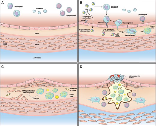 Role of LDL in the development of atherosclerotic lesions. (A) normal vascular wall. (B) endothelial dysfunction. (C) initiation of atherosclerotic lesion formation. (D) atherosclerotic plaque formation. EC, endothelial cells; SMC, smooth muscle cells; CAM, cell adhesion molecules.