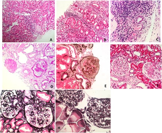 Renal tissue under LM. (A) Interstitial inflammatory infiltrate and tubulitis on haematoxylin and eosin (H&E) stain in a patient with ADTKD-HNF1B. (B) Interstitial inflammatory infiltrate and tubulitis on H&E stain in a patient with ADTKD-UMOD. (C) Interstitial inflammatory infiltrate and tubulitis on H&E stain in a patient with ADTKD-unknown. (D) Global and segmental glomerulosclerosis on perisodic acid–schiff stain in a patient with FSGS due to autosomal dominant INF2 mutation. (E) Glomerulosclerosis on silver stain in a patient with a COL4A4 mutation. (F) Segmental glomerulosclerosis on H&E stain in a patient with primary FSGS, genetics unknown. (G) Capillary loop thickening and double contour formation on silver stain in a patient with hereditary C3 nephropathy. (H) Capillary loop thickening and double contour formation on silver stain in a patient with hereditary C3 nephropathy.
