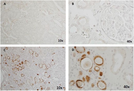 Immunohistochemical staining of renal biopsy tissue samples showing positive MUC1fs staining in affected individuals with ADTKD-MUC1 and negative MUC1fs staining in controls. (A) Kidney section from a negative control at 10× magnification. (B) Negative control at ×40 magnification. (C) Kidney section from an individual affected by ADTKD-MUC1 at ×10 magnification, showing positive staining of the distal tubules and collecting ducts at ×20 magnification. (D) Kidney section from an individual affected by ADTKD-MUC1 at ×20 magnification, showing positive staining of the distal tubules and collecting ducts at ×20 magnification.