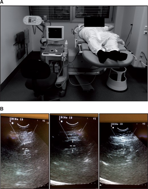 LI-SWT treatment with the Modulith SLX-2 lithotripter. (A) Patients were laid on their back or side while treatment was carried out. The shockwave source is found beneath the table under the patient’s lumbar region. Water was used as coupling between the patient and the lithotripter. (B) The kidneys were treated with 1000 shockwaves at the upper, middle and lower part (3000 in total for each kidney). Energy level was increased from 0.136 mJ/mm2 to 0.265 mJ/mm2 during the first 200 shocks at each part of the kidney. The final 800 shockwaves were applied with 0.265 mJ/mm2. The shockwaves were administered with 4 Hz and extended focal size. Both kidneys were treated at each session.