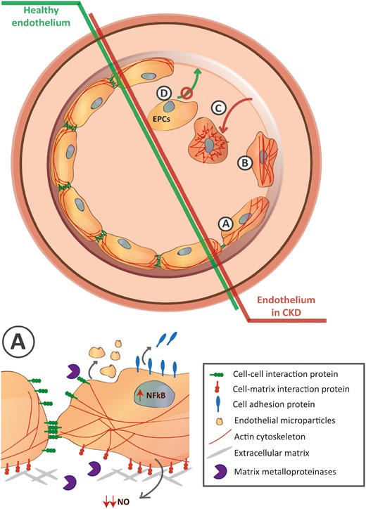 CKD disrupts the endothelial cell lining through different mechanisms. Representative different pathological mechanisms are highlighted from A to D. (A) Enlargement in the bottom. Activation of the NF-κB results in elevated soluble cell adhesion molecules characteristic of endothelial cell activation accompanied by the increase of matrix metalloproteinases that disrupt the endothelial cell–cell and cell–matrix interactions. Rearrangement of F-actin cytoskeleton towards the formation of stress fibers results in changes in endothelial cell morphology. Uraemia also enhances the release of endothelial cell microparticles and reduces the NO bioavailability. (B) Those mechanisms result in the contraction of the endothelial cell and disassociation of adjacent cells and base membrane. (C) As a result, endothelial cells detach reflecting the loss of the endothelial cell lining. (D) In addition, the limited amount of circulating EPCs accompanied by an impaired normal progenitor function and limited adhesion capacity results in an abnormal recovery of the endothelium against the uraemia-mediated damage.