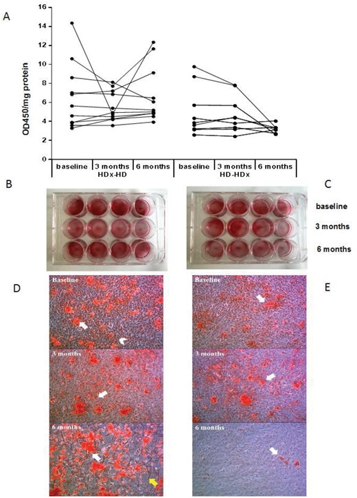 Calcification in VSMCs coultered with 10% uremic serum and challenged with 3.3 mM Pi for 3 days. Panel A left, B and D 0-3 months HDx and 3-6 months HD. Panel A right, C and E 0-3 months HD and 3-6 months HDx.