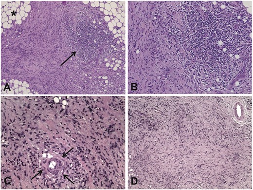 Main histological patterns in patients with IRF. (A) Low-power view of a retroperitoneal biopsy from a patient with IRF shows a fibro-inflammatory tissue replacing the normal retroperitoneal adipose tissue (asterisk); the arrow indicates a nodular aggregate of inflammatory cells, which is located within a highly fibrous tissue. Haematoxylin and eosin, ×10. (B) A higher magnification view of the histological field shown in (A) shows that the nodular aggregate is mainly comprised mononuclear inflammatory cells. Haematoxylin and eosin, ×20. (C) High-power view of a retroperitoneal biopsy from a patient with IRF shows that the thick collagen bundles are often organized around small blood vessels (arrows). Haematoxylin and eosin, ×20. (D) Low-power view of a retroperitoneal biopsy from an IRF patient with long disease duration shows mainly compact and storiform fibrosis. Haematoxylin and eosin, ×10.
