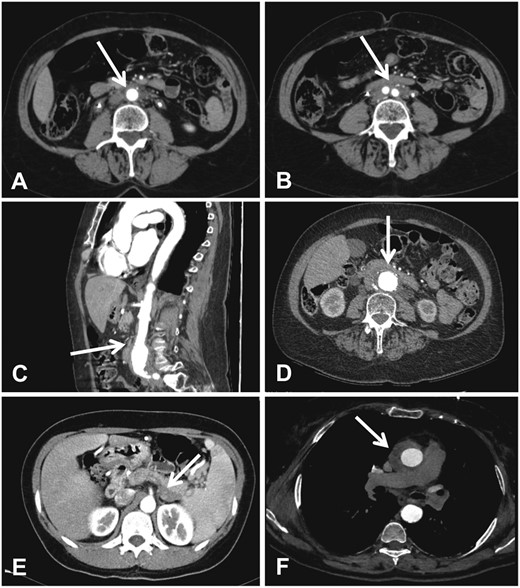 Main CT findings in patients with IRF. (A and B) Contrast-enhanced CT (axial views) of the abdomen in a patient with IRF shows the typical peri-aortic (A) and peri-iliac (B) (arrows) muscle-isodense tissue. (C and D) Contrast-enhanced CT (sagittal view in C, axial view in D) of the abdomen in a patient with perianeuruysmal retroperitoneal fibrosis shows that the muscle-isodense tissue surrounds an aneurysmal and highly calcified abdominal aorta. (E) Contrast-enhanced CT of the abdomen in a patient with IgG4-related autoimmune pancreatitis shows a retroperitoneal hypodense tissue adjacent to the pancreatic tail (arrow). (F) Contrast-enhanced CT of the chest in a patient IRF associated with thoracic periaortitis shows an isodense tissue around the ascending thoracic aorta (arrow).