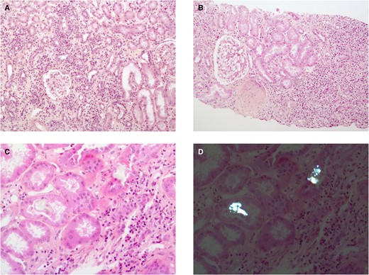 Histological features of AIN. (A) A case of interstitial inflammatory infiltrate, tubulitis and interstitial oedema (haematoxylin and eosin and saffron staining, original magnification ×100). (B) A case with severe interstitial fibrosis containing dense inflammatory infiltrate (Masson’s trichrome staining, original magnification ×100). (C and D) The usefulness of polarized light microscopy (D) to detect intratubular, unstained crystals (C, haematoxylin and eosin and saffron, original magnification ×200) with slight interstitial inflammation.
