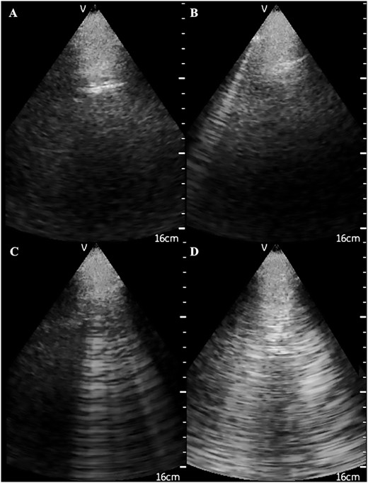 Ultrasonographic appearance of (A) normal lungs and the presence of (B) 1, (C) 4 and (D) 10 US B-lines.