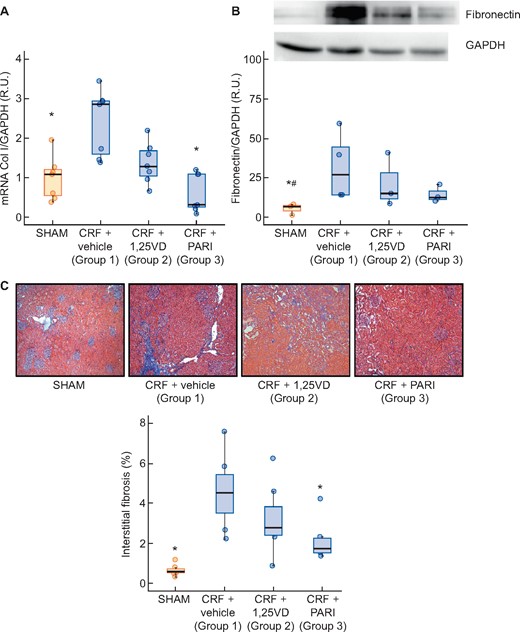 Collagen I gene expression evaluated by qPCR and renal interstitial fibrosis: Masson’s thrichromic staining. SHAM-operated (SHAM); CRF rats + vehicle (CRF + vehicle, Group 1), CRF rats + calcitriol (CRF + 1,25VD, Group 2), CRF rats + paricalcitol (CRF + PARI, Group 3). (A) Collagen I (Col I) mRNA. (B) Representative Western blot of fibronectin and GAPDH and Fibronectin western blot quantification. (C) Masson’s trichrome staining interstitial fibrosis representative photo of Masson’s trichrome staining 10× and quantification in all rats. Data represent median and interquartile range. *P < 0.05 versus CRF + vehicle; #P < 0.05 versus CRF + 1,25VD.