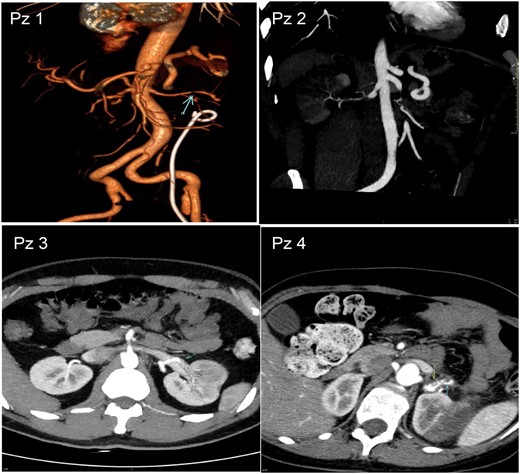 Abdominal CTA of 4 patients with SRAD after therapy