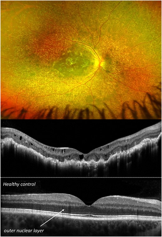 Pseudo-colour fundus image (top) and optical coherence tomography (OCT) (middle) of an infantile primary hyperoxaluria type 1 patient with severe retinal alterations and oxalate deposits. For comparison, OCT of a healthy control is shown (bottom).
