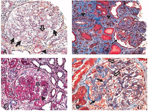 CG associated with other significant renal diseases. (A) TMA. The glomerulus shows segmental tuft collapse (closed arrows). The vascular pole is ‘occluded’ by activated mononuclear cell elements (endothelial cells and/or myofibroblasts; open arrow). The arrowhead points to arteriolar wall changes with intramural hyaline deposits often seen in TMAs. (B) Severe AS. The glomerulus shows segmental tuft collapse (closed arrow). An interlobular artery and pre-arteriole show severe, stenosing hypertension-induced intimal widening including fibroelastosis (arrowheads). Fibrosis, tubular atrophy and few small tubular microcysts are noted in the tubulo-interstitial compartment. (C) Diabetic glomerulopathy. The glomerulus shows segmental podocyte crowding (arrow) and segmental collapse of ‘non-nodular’ tufts (open arrow). The afferent arteriole at the vascular pole demonstrates severe stenosing hyalinosis (arrowhead). (D) MGN. The glomerulus shows global thickening of capillary walls (open arrows) and collapse of a tuft segment (closed arrows). (Typical immunofluorescence and ultrastructural features confirmed a diagnosis of MGN.) Masson trichrome stains, 40× original magnification (A) and (D), 20× (B) and (C).