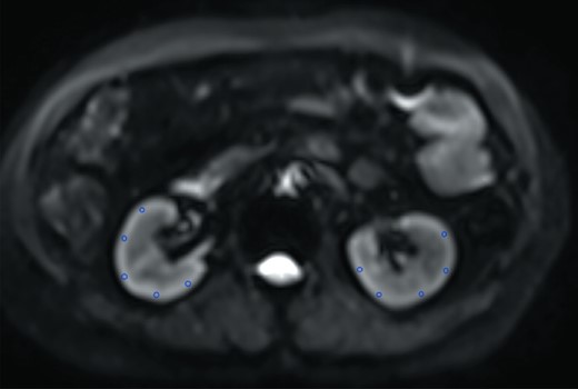 Representatives of multiple ROIs for bilateral cortexes at the mid-zone of the both kidneys on the b = 0 mm2/s image. The same ROIs were then copied to maps of all metrics.