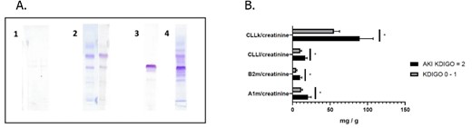 A. Different urinary profiles in UPE. 1: Normal profile, 2: Tubular profile, 3: Glomerular profile, 3: Mixed profile. B. Urine protein assay in COVID ARDS patients with and without AKI KDIGO ≥ 2 in univariate analysis.