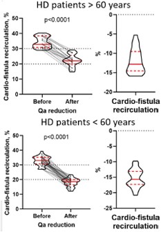 Changes in cardio-fistula recirculation as a result of Qa reduction in HD patients >60 and <60 years old.