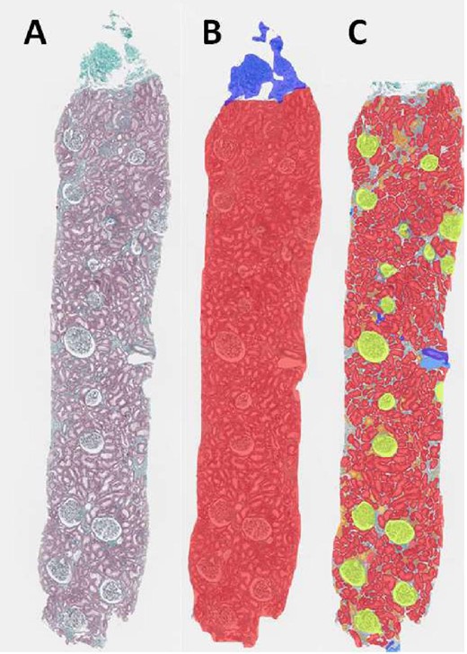 Kidney samples stained with Masson's trichrome before and after the two first consecutive convolutional neural networks predictions (B, C). B: Cortical area (red), capsule (deep blue), C: normal and atrophic tubules (red and orange), non-sclerotic glomeruli (yellow), sclerotic glomeruli (light blue), arteries (purple), vein (deep blue).