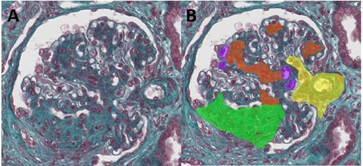 Kidney samples stained with Masson's trichrome before (A) and after the last convolutional neural networks predictions (B). B: hilum (yellow), mesangial hypercellularity (red), endothelial hypercellularity (purple), segmental glomerulosclerosis (green).