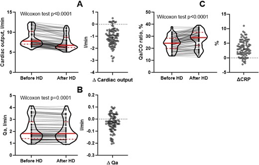 Changes in CO, Qa and Qa/CO ratio (CPR) before and after hemodialysis session.