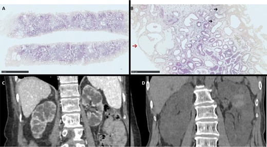 Histological and radiological features from patient. (A, B) Kidney histology H&E staining showing at low magnification (HES ×2.5) low to moderate fibrosis with pseudocystic dilatation of the tubules and at higher magnification (HES ×10) interstitial lymphocytic infiltrate (dark arrow) and pseudocystic tubular dilatation (red arrow). (C, D) Computed tomography (CT) showing renal cysts in Patients A and B, respectively.