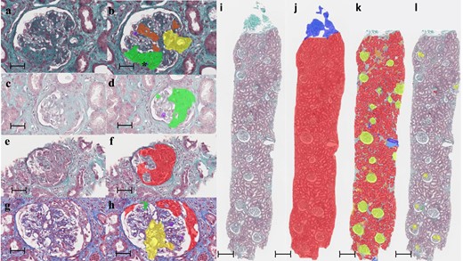 Evaluation by the algorithms of kidney lesions in IgAN. Kidney biopsies stained with Masson's trichrome. Comparison of images before processing (a, e, c, g) and after processing (b, f, d, h) by the third algorithm focused on glomerular lesions. Scale bars: 50 µm, 400× magnification. The lesions on the treated images were automatically and artificially coloured in red, green, purple, orange and yellow for lesions of the crescent, glomerular sclerosis, endocapillary hypercellularity, mesangial hypercellularity and vascular stalk, respectively. *Abnormally segmented endocapillary hypercellularity within fibrosis area. (i–l) Kidney biopsy M0E1S1T0C0 of a patient evaluated by the three consecutive neural network algorithms. Scale bars: 500 µm, 25× magnification. (i) Biopsy before segmentation. (j) Biopsy after segmentation by the first algorithm to isolate the cortical area. The capsule is coloured in blue and the cortex in red. (k) Cortical area isolated after segmentation by the second algorithm to assess T status and isolate glomeruli. Glomeruli are coloured in yellow, healthy tubules in red, atrophic tubules in orange, arteries in dark blue and veins in light blue. (l) Glomeruli within the cortical zone after segmentation by the third neural network to calculate M, E, S and C scores. There is an area falsely identified as a crescent.