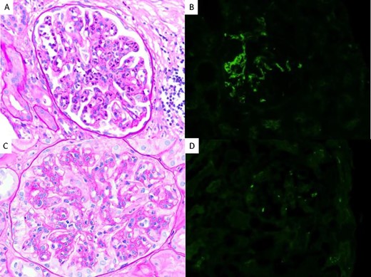 Case 1: kidney transplant biopsies. Superior: first biopsy with C3GP recurrence diagnosis. (A-B) Light microscopic showing endocapilar proliferation (A), periodic acid-Schiff (PAS). (B) Immunofluorescence with strong C3 deposition. Inferior: biopsy control after 5 months of iptacopan beginning. (C-D) Light microscopic with persistent endocapillary proliferation with mesangial proliferation and presence of double contours pattern, PAS. (D) Immunofluorescence with C3 impregnation but no significant deposits. Original magnification, × 100 in A, B, C, D.