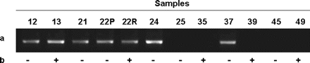 Methylation-specific PCR on the CpG island at the 5' of the TNFRSF8 gene. A 164-bp methylation-specific band was identified in 7 of 12 patients (a). In seven samples, the methylation status was in accord with the expression status by reverse transcriptase PCR (b). +, TNFRSF8 expression; -, no expression.