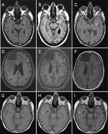 Noncontrast T1-weighted MRI of three patients who developed intraparenchymal hemorrhages while on anticoagulation and bevacizumab. (A–C) Images for patient 1 were obtained prior to treatment (A), 39 days later at the time of symptoms from hemorrhage (B), and 2 months later on follow-up, while still on bevacizumab (C). (D–F) Images of patient 2 were obtained before treatment (D), at 1 month before hemorrhage (E), and at the time of hemorrhage (F). (G–I) Images for patient 3 were obtained prior to (G), 2 months after (H), and 6 months after (I) starting both anticoagulation and bevacizumab.