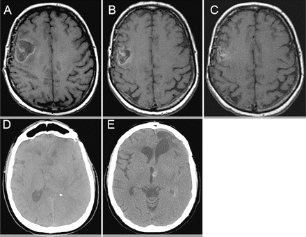 Noncontrast T1-weighted MRI (A–C) and noncontrast head CT (D and E) from two patients with petechial hemorrhages while on anticoagulation and bevacizumab. (A–C) Patient 4 initial scan (A), 1 month after (B), and 4 months after (C) being on both treatments. (D and E) Patient 5 images obtained before (D) and 4 months after (E) both treatments had started.
