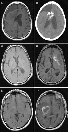 Representative imaging from patients 1, 4, and 5 with major hemorrhages but not on anticoagulation. (A and B) Patient 1 noncontrast T1-weighted MRIs before bevacizumab (A) and 1 month after (B). (C and D) Noncontrast T1-weighted MRIs for patient 4 obtained before treatment (C) and almost 5 months later (D). (E and F) Images for patient 5 were obtained from before (E) and 3 months after (F) bevacizumab.