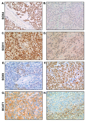Immunohistochemistry for SOX4, SOX11, SOX9, and BCAT1 in medulloblastoma and ependymoma. Immunohistochemistry confirmed the overexpression of SOX4 in medulloblastoma (A) compared with ependymoma (B). SOX11 protein expression was also shown to be higher in medulloblastoma (C) compared with ependymoma (D). In contrast, SOX9 expression was confirmed to be higher in ependymoma (F) compared with medulloblastoma (E). (G and H) Representative images of strong homogeneous cytoplasmic staining of BCAT1 and focal BCAT1 staining, respectively, in predominantly metastasized medulloblastoma.