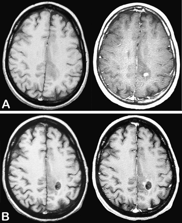 Example of biopsy sampling performed on the area of contrast enhancement. Axial T1-weighted sequences before (left) and after (right) injection of gadopentetate dimeglumine showing a small nodular-like contrast enhancement at the time of histological diagnosis (A) and after biopsy sampling (B). This case was taken from the gliomas under study.