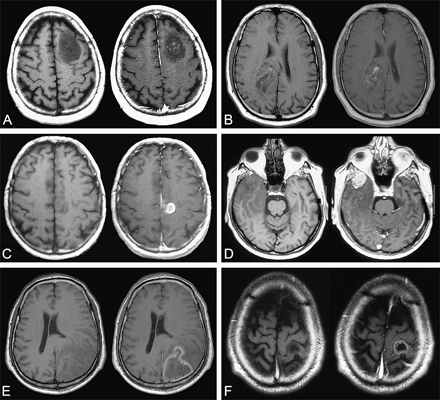 Examples of MRI patterns of contrast enhancement on axial T1-weighted sequence before (left) and after (right) injection of gadopentetate dimeglumine. (A and B) Patchy and faint pattern of contrast enhancement. (C and D) Nodular-like pattern of contrast enhancement. (E and F) Ring-like pattern of contrast enhancement. A–D were taken from the gliomas under study; E and F were taken from a high-grade glioma library.