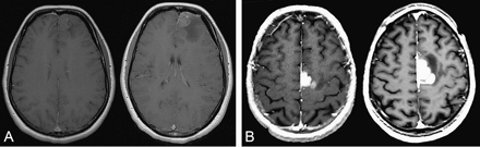 Examples of MRI time-progressive contrast enhancement before oncological treatment on axial T1-weighted sequence after injection of gadopentetate dimeglumine. (A) Time-progressive contrast enhancement at 2-month interval. (B) Time-progressive contrast enhancement at 3-month interval. A and B were both taken from the gliomas under study.