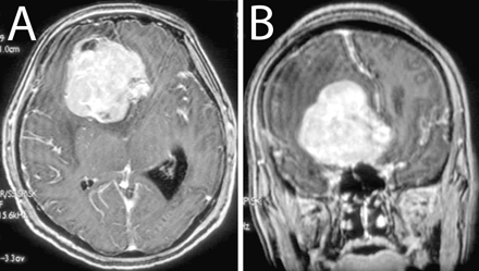 Axial (A) and coronal (B) gadolinium-enhanced T1-weighted MRI at presentation.