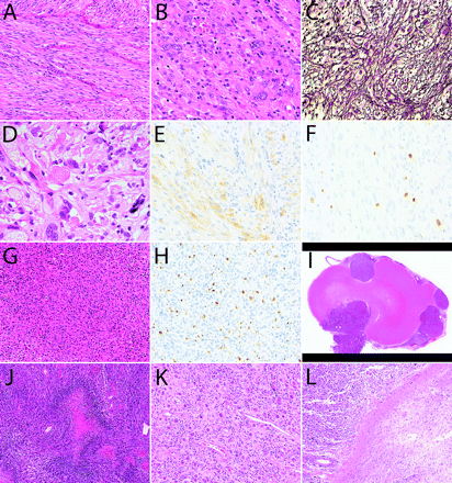 (A–F) First surgical specimen demonstrating spindle cells (A), pleomorphic cells (B), reticulin fibers (C), eosinophilic protein droplets (D), and cells positive for glial fibrillary acidic protein (E). MIB-1 (mindbomb homolog 1) labeling index was 4% (F). (G and H) Recurrent tumor showing high cellularity (G) and MIB-1 labeling index (H). (I–L) Autopsy specimens showing well-demarcated (I), highly cellular tumor (J) and less cellular region (K) adjacent to degenerated white matter (L). Staining: A, B, D, G, and I–L, hematoxylin and eosin staining; C, silver staining; E, immunostaining for glial fibrillary acidic protein; F and H, MIB-1 staining. Original magnification: A, G, and K, ×200; B, C, E, F, and H, ×400; D, ×800; I, ×10; J and L, ×100.