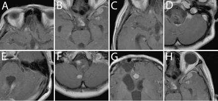 Gadolinium-enhanced T1-weighted MRI at 60 months. A–H correspond to the lesions treated with SRS shown in Fig. 3A–H.