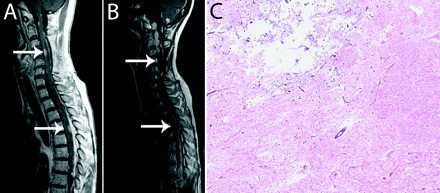 (A and B) Gadolinium-enhanced T1-weighted MRI of the spinal cord showing lesions before STI (A, white arrows) that were controlled until 60 months (B, white arrows). (C) Autopsy specimen of the spinal cord adjacent to irradiation field showing the area of radiation necrosis (hematoxylin and eosin staining; original magnification, ×50).