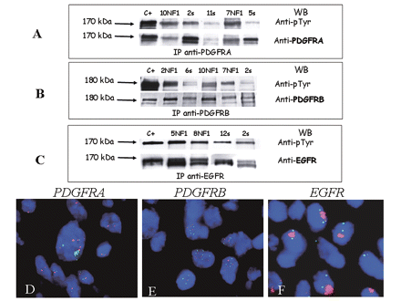 (A–C) Receptor tyrosine kinase (RTK) biochemical analyses. (A) Platelet-derived growth factor (PDGF) receptor A (PDGFRA) immunoprecipitation (IP) and Western blotting (WB) experiments revealed a 170-kDa band corresponding to the activated (upper arrow) and expressed (lower arrow) receptor in the tumor samples. PDGFRA phosphorylation levels were similar to (cases 10 neurofibromatosis type 1 [NF1], 7 NF1, and 2s) or less intense than (cases 11s and 5s) those found in the positive control (NIH3T3 cell line). pTyr, phosphorylated tyrosine. (B) PDGF receptor B (PDGFRB) IP and WB revealed a 180-kDa band corresponding to activated (upper arrow) and expressed (lower arrow) PDGFRB in all analyzed cases. The samples showed different phosphorylation levels: similar to (NF1-related cases 10 [10NF1] and 7NF1), more intense than (case 2NF1), or less intense than (cases 6s and 2s) those observed in the 2N5A cells used as positive controls. (C) Epidermal growth factor receptor (EGFR) analysis revealed a band of 170 kDa in all of the analyzed samples, thus indicating the presence of activated (upper arrow) and expressed (lower arrow) EGFR. The level of phosphorylation was similar to (cases 12s and 2s) or more intense than (cases 5NF1 and 8NF1) those observed in the positive controls (Cal27 cell line). C+, positive control; s, sporadic case. (D–F) RTK fluorescence in situ hybridization analyses. (D) The nuclei in sporadic case 2 showed PDGFRA gene amplification (green cluster) in a high-polysomy chromosome 4 (centromere 4, red signals) where PDGFRA is located (green signals). (E) The nuclei in NF1-related case 2 showed a high-polysomy chromosome 5 (centromere 5, red signals) where PDGFRB is located (green signals). (F) The nuclei in NF1-related case 1a showed EGFR gene amplification (red cluster) in disomy represented by two centromere 7 signals (green signals).