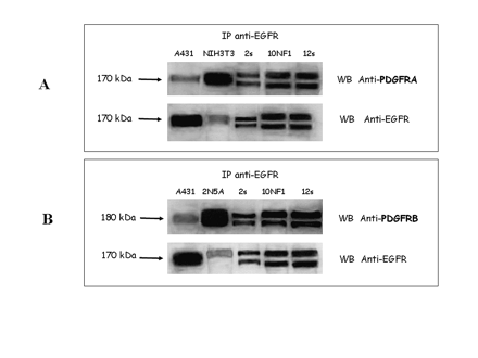 Epidermal growth factor receptor (EGFR)–platelet-derived growth factor (PDGF) receptor A (PDGFRA) and EGFR–PDGF receptor B (PDGFRB) heterodimerization. (A) EGFR immunoprecipitation (IP) and PDGFRA Western blotting (WB) experiments revealed a 170-kDa band corresponding to PDGFRA showing similar expression in all three analyzed cases (sporadic cases 2 [2s] and 12s and NF1-related case 10 [10NF1]). NIH3T3 cell lines were used as positive control for PDGFRA. Afterward, the filter was stripped and incubated with EGFR antibody, which revealed a band of 170 kDa in all of the analyzed samples, thus indicating less intense expression of EGFR than observed in the positive control A431 cells. (B) EGFR IP and PDGFRB WB experiments revealed a 180-kDa band corresponding to PDGFRB showing similar expression in all three analyzed cases (cases 2s, 10NF1, and 12s). 2N5A cell lines were used as positive control for PDGFRB. Afterward, the filter was stripped and incubated with EGFR antibody, which revealed a band of 170 kDa in all of the analyzed samples, thus indicating the expression of EGFR.