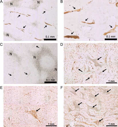 Brain tumor histology. Brain sections were obtained from untreated control study rats (A and D), and rats treated with intetumumab (30 mg/kg i.v.; B and E) or bevacizumab (45 mg/kg i.v.; C and F). VEGFR1 immunohistochemistry (A–C) shows tumor blood vessels, indicated by arrows; N, areas of necrosis; bar indicates 0.1 mm. CD68 immunohistochemistry for macrophages (D–F) shows the areas of necrosis (arrows); bar indicates 1 mm.