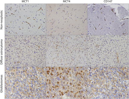Immunohistochemical expression of monocarboxylate transporters and their chaperone protein CD147 in glioma samples. MCT1 and MCT4 isoforms and their chaperone CD147 presented weak cytoplasmic expression in few cases of nontumoral cerebral tissue. Diffuse astrocytomas presented cytoplasmic expression of MCT1, MCT4, and CD147. Glioblastoma tissues present a strong expression of MCT1 and CD147, mainly at the plasma membrane, whereas MCT4 reactivity was found in both the cytoplasm and the plasma membrane. Pictures were obtained using the microscope Olympus BX61, at 400× magnification.