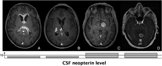 MRI scans from 3 patients with biopsy-proven final diagnosis and corresponding CSF neopterin levels with cut-off value at 10 nmol/L. A and B: glioblastoma with atypical MRI, suggestive of PCNSL and with low CSF neopterin level. C: deep located PCNSL and high CSF neopterin level. D: PCNSL with atypical MRI and high CSF neopterin level.