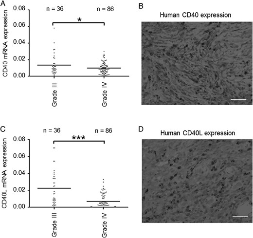 CD40/CD40L gene expression and immunohistochemistry in glioma tissues. (A) CD40 gene expression analyzed by quantitative PCR in glioma tissues. Expression of CD40 was significantly higher in 36 cases of grade III gliomas than in 86 cases of grade IV glioblastomas (GBM) (*P = .0334). (B) Representative immunohistochemical image of CD40 in GBM tissues that revealed the high expression of CD40 by quantitative PCR. CD40-positive GBM cells were detected. Scale bar, 100 μm. (C) CD40L gene expression analyzed by quantitative PCR. Expression of CD40L was significantly higher in grade III gliomas than in grade IV GBM (*P< .0001). (D) Representative immunohistochemical image of CD40L in GBM tissues that revealed the high expression of CD40L by quantitative PCR. CD40L-positive GBM cells were detected. Scale bar, 100 μm.