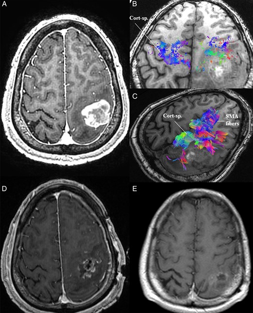 (A) MRI of the brain in Case 1 demonstrated a contrast-enhancing lesion in the left postcentral gyrus with associated perilesional edema. (B) Preoperative high-definition fiber tractography (HDFT) revealed an anteriorly displaced corticospinal (Cort-sp.) tract compared with the contralateral side as demonstrated by the cortical end points of the tract. (C) Preoperative HDFT was used to demonstrate the corticospinal and supplementary motor area (SMA) fibers coursing adjacent to the lesion in the edematous zone. (D) Early postoperative MRI of the brain with contrast demonstrated a resection cavity in the postcentral gyrus, limited anteriorly due to the location of the precentral gyrus and preoperatively identified displaced corticospinal tracts. (E) A delayed follow-up MRI after chemoradiotherapy shows evidence of resolution of some of the postoperative residual tumor.