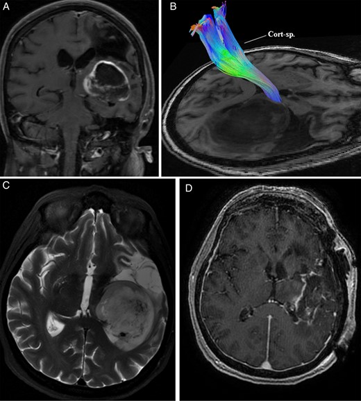 (A) MRI of the brain in Case 2 demonstrated a left-sided contrast-enhancing basal ganglia mass with evidence of a previous middle cerebral artery territory infarction. (B) Preoperative high-definition fiber tractography revealed a displaced corticospinal tract (Cort-sp.) in the perilesional area. (C) T2-weighted MRI of the brain further delineated the tumor. (D) Postoperative contrast-enhanced MRI showed a residual cuff of tumor along the margin adjacent to the corticospinal tract and thalamus.