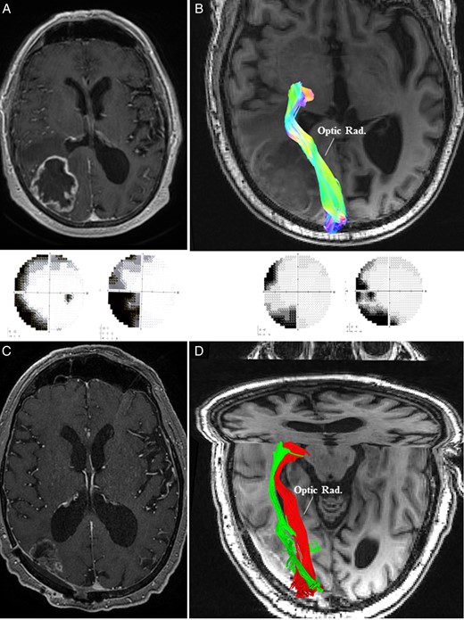 (A) MRI of the brain in Case 3 demonstrated a right-sided contrast enhancing parieto-occipital lesion leading to left-sided homonymous hemianopia (panel below). (B) Preoperative high-definition fiber tractography (HDFT) showed medially and inferiorly displaced optic radiation (Optic Rad.) in the perilesional edematous area. (C) Postoperative MRI with contrast confirmed an adequate resection with a small residual on the medial margin adjacent to the optic radiation. (D) Postoperative HDFT confirmed the improvement in the configuration of the displaced optic radiation (red: preoperative; green: postoperative). This was accompanied by an improvement in the visual field deficit (panel above).