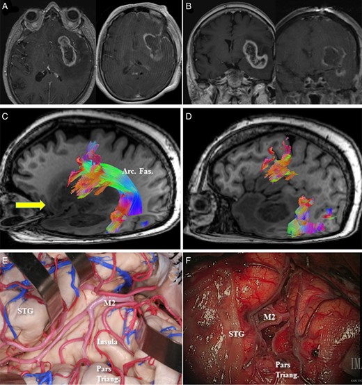 (A, axial) and (B, coronal) Preoperative MRI with contrast in Case 4 demonstrated an enhancing left insular lesion with extension into the fronto-orbital operculum and the temporal lobe. (C) Preoperative high-definition fiber tractography (HDFT) demonstrated the course of the arcuate fasciculus (Arc. Fas.) through the perilesional edematous area. Arrow (yellow) represents the site of the corticotomy in the frontal operculum. (D) Frontal termination of the arcuate fibers was identified in the pars opercularis, precentral gyrus, and middle frontal gyrus using HDFT and to help with the decision-making regarding the site of corticotomy in the frontal operculum. (E) A representative anatomical view in a cadaveric specimen shows the insula with overlying M2 branches of the middle cerebral artery and the location of the pars triangularis (Pars triang.) and the superior temporal gyrus (STG). (F) A comparable intraoperative view is presented after debulking of the tumor in between the M2 branches. The location of the pars triangularis is demonstrated.