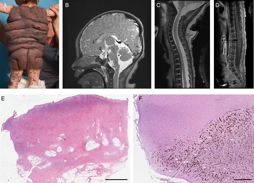 (A) Massive garment-like giant nevus (patient C76N). (B) Sagittal MRI with contrast of patient P01S showing dilatation of fourth ventricle (asterisk) and leptomeningeal melanocytic deposits (arrow). (C) Sagittal MRI image of the upper spinal cord (patient P01S). Note the increased signal around the spinal cord. (D) Sagittal MRI image without contrast of the lower spinal cord (patient P01S). A syrinx is noted at the lumbar level (arrow). (E) Skin nevus from patient C76N showing massive dermis and subcutaneous proliferation of nevus cells with increased amount of collagen (scanned image, H&E, 0.6×, scale bar = 5 mm). (F) Hippocampus with extensive pigmentation due to invading melanocytic cells in patient P09B (scanned image, H&E, 0.6×, scale bar = 1 mm).